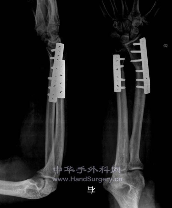 术后半年.jpg