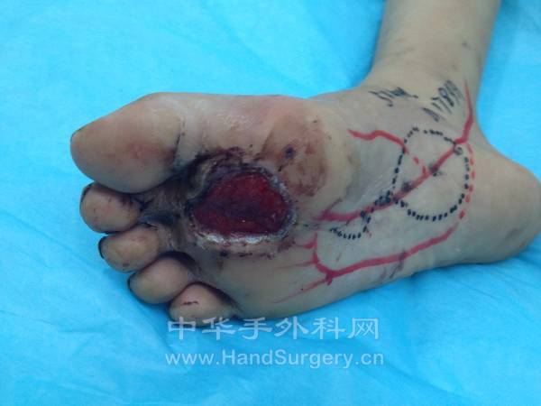 右足跖底组织损伤情况