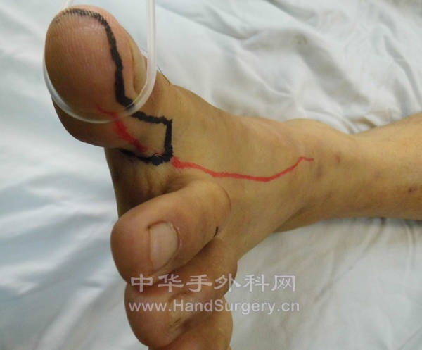 皮瓣设计