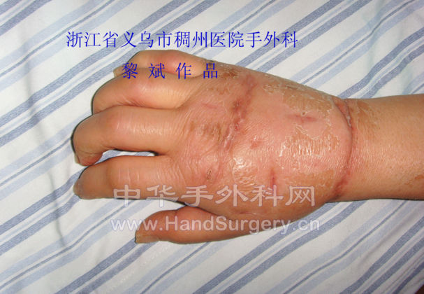 术后1个月随访