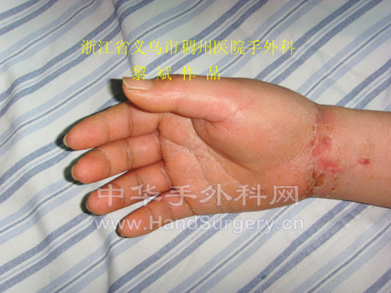 术后1个月随访