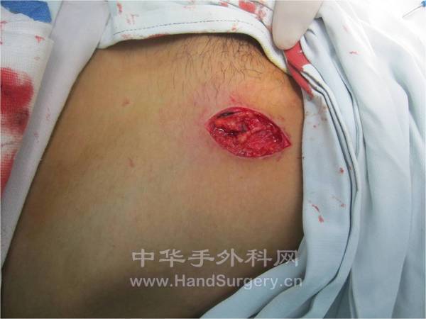 第一步，于腹股沟韧带中点下端附近触摸到动脉搏动最强点，做一纵行切口，显露旋髂浅动脉及腹壁浅动脉 ... ...