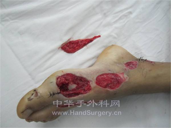 患者跖背动脉发育不全，术中与近端足背动脉吻合