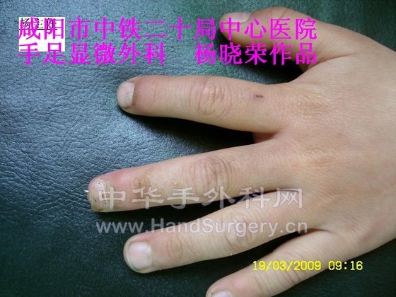 2愈后