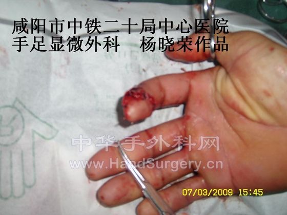 3术后