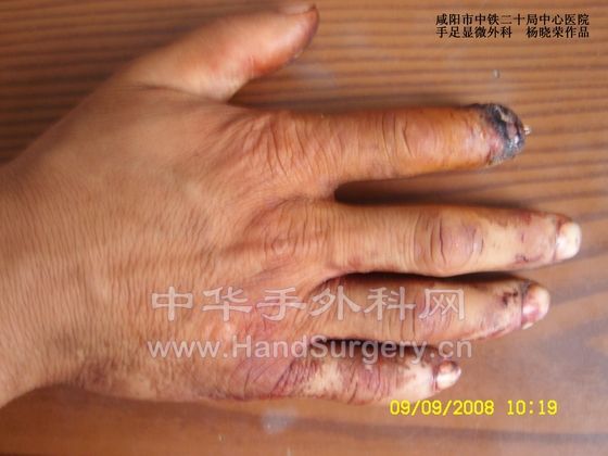 5愈后