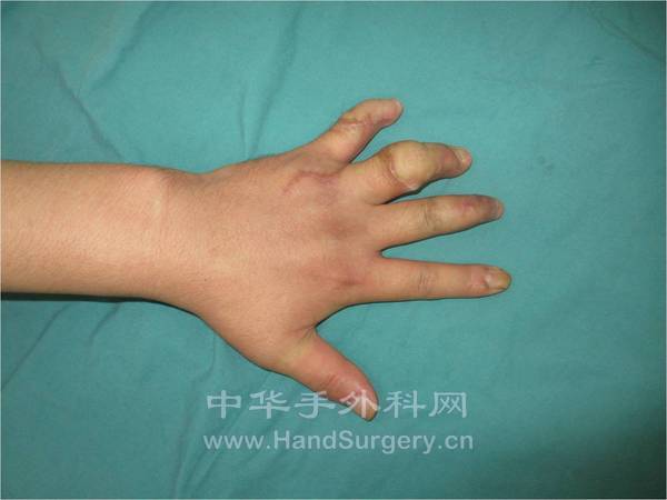 皮瓣修复术后2.5个月