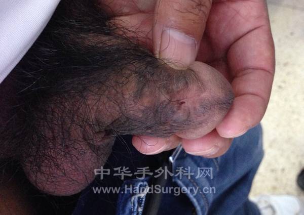 尿道下裂 十几年，修补术后一年多，先瘘道不愈合