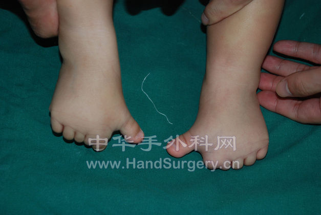 拇趾无屈伸活动