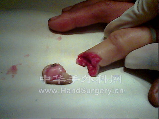 余新华一右食指甲根部完全离断(背侧)2008年11月15日.jpg