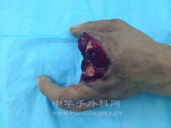 左手食中指损伤情况