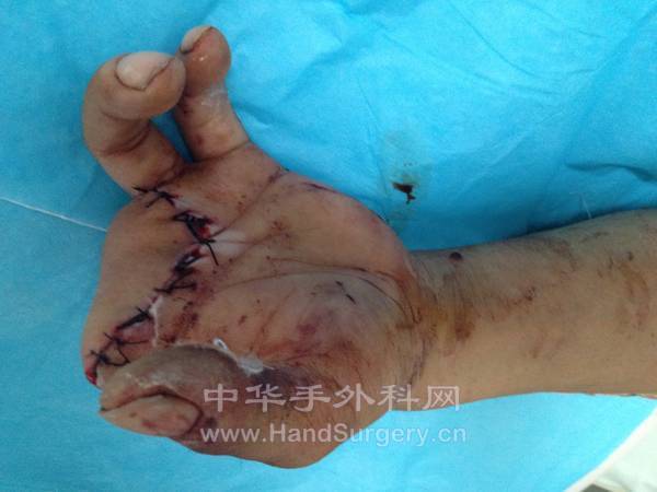 术后3天掌侧情况