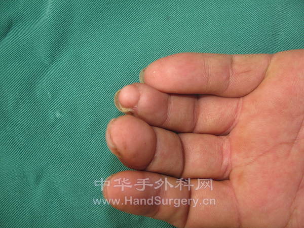 术后三个月复查
