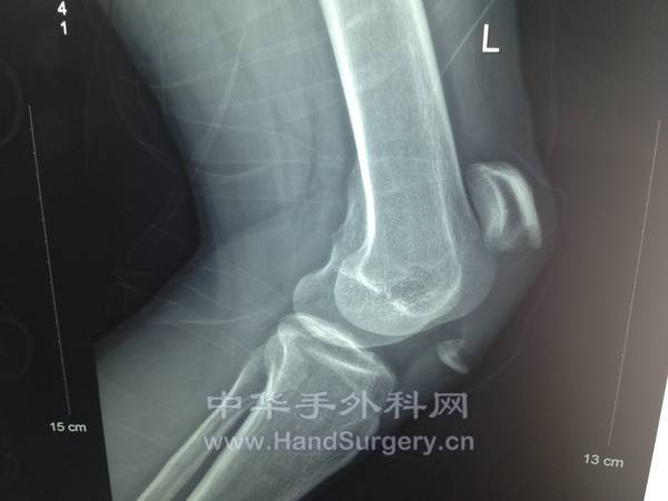 髌骨骨折情况