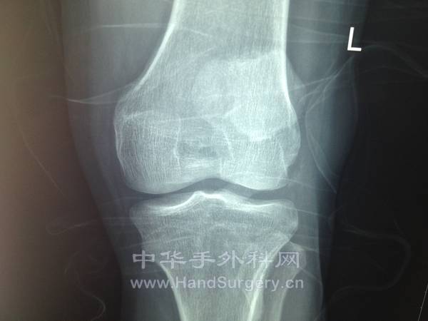 骨折情况