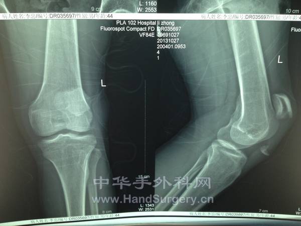 骨折情况