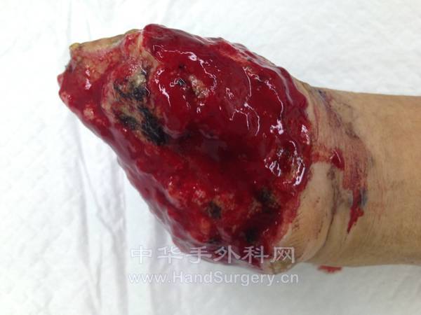 右手毁损情况