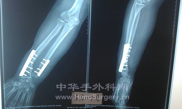 术后十个月.jpg