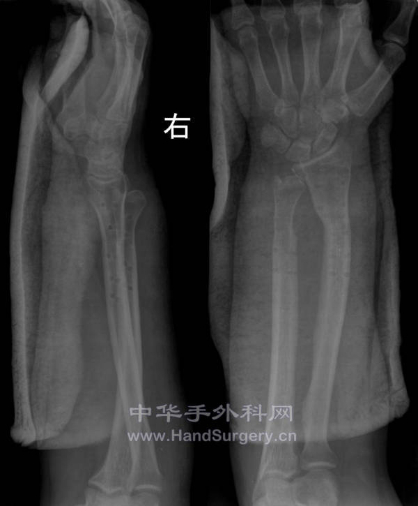 术后十个月取钢板后.jpg