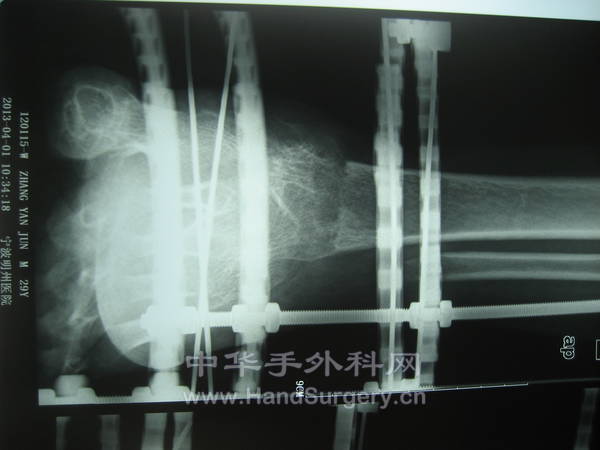 术后10个月