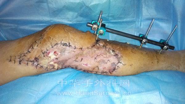 术后成活情况