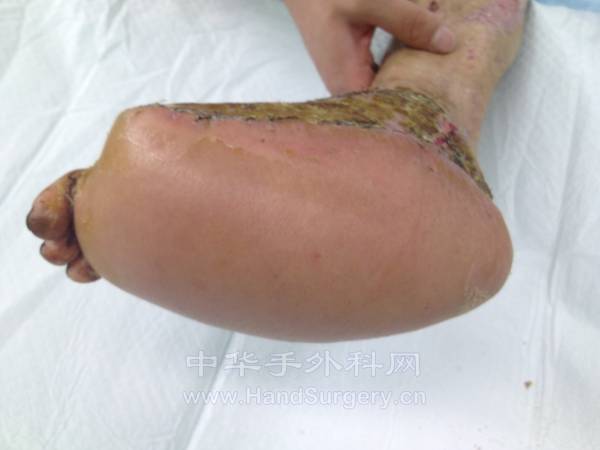 修复术后