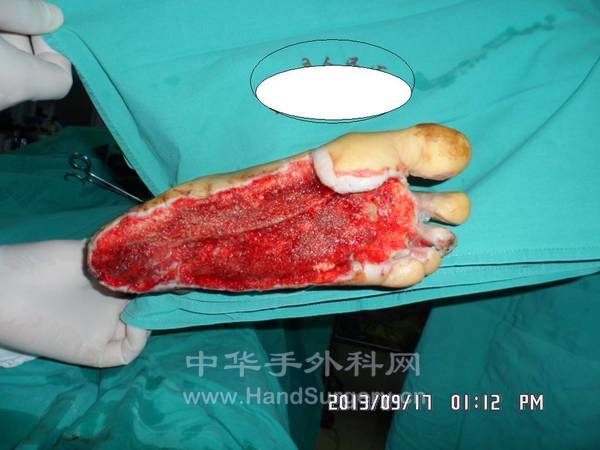 术前VSD拆除术后