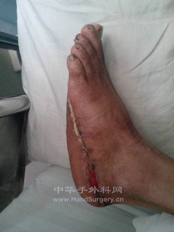术后1月