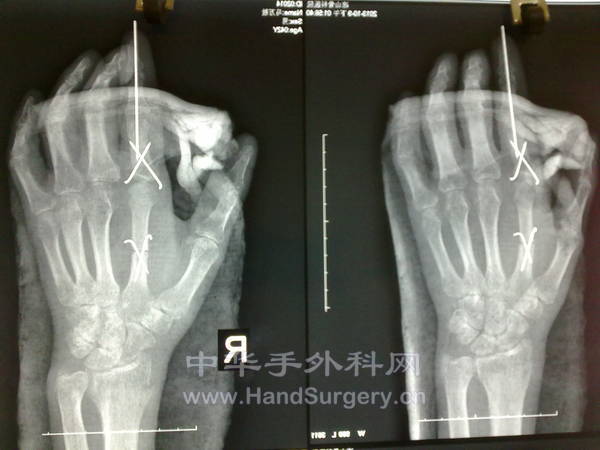 同样也是第二趾跖关节移植再造示指掌指关节