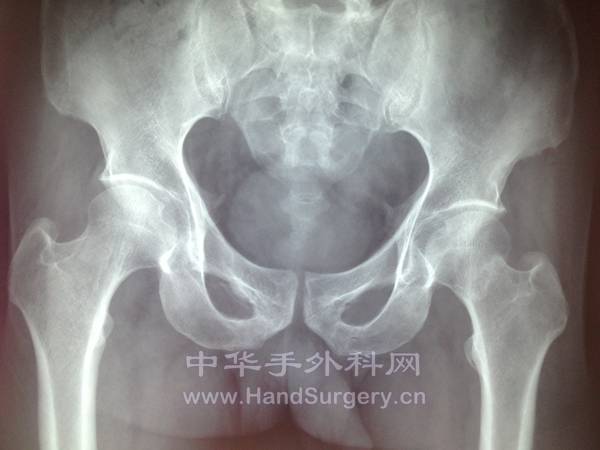 左股骨颈骨折