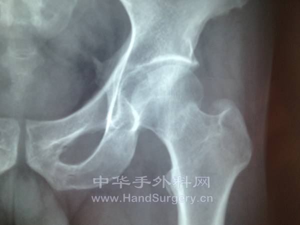 骨折情况，断端嵌叉股骨颈长度变短