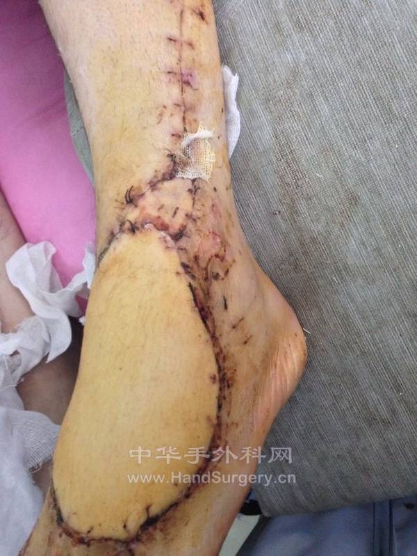 拆线出院