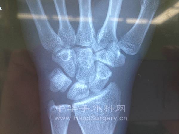 x片显示舟骨体部骨折