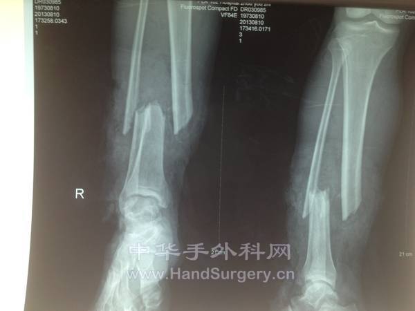 右胫腓骨骨折情况