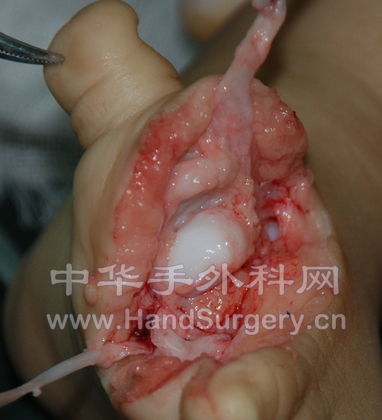 1跖骨头关节面倾斜DSC_6001.JPG