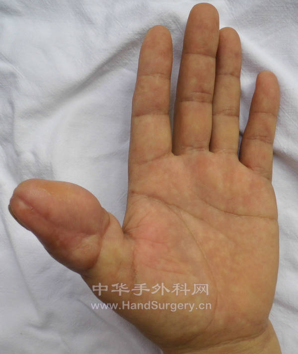 术后复查，皮瓣臃肿