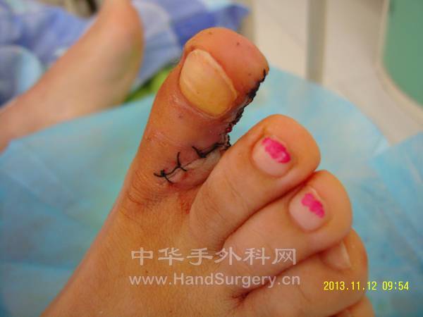 足部供区1.jpg
