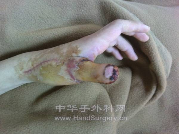 踇甲瓣再造术后3周