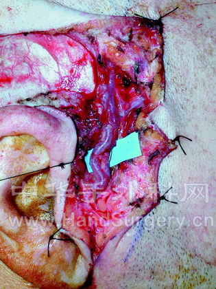 temporal artery and vein.jpg