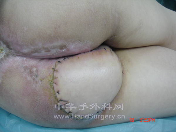 术后20天