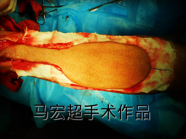 术中