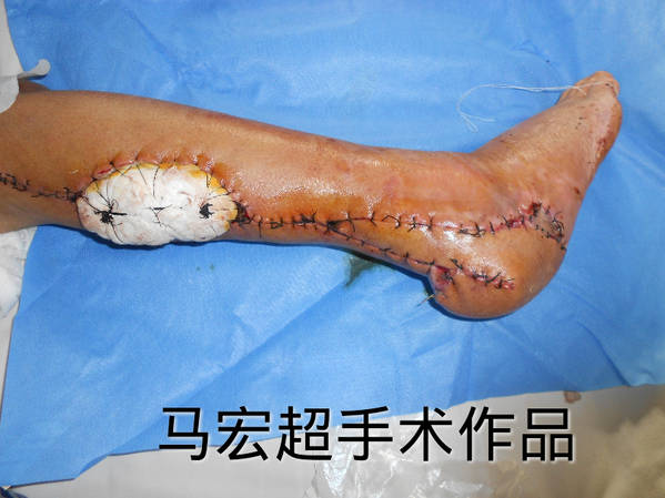术后皮瓣成活良好