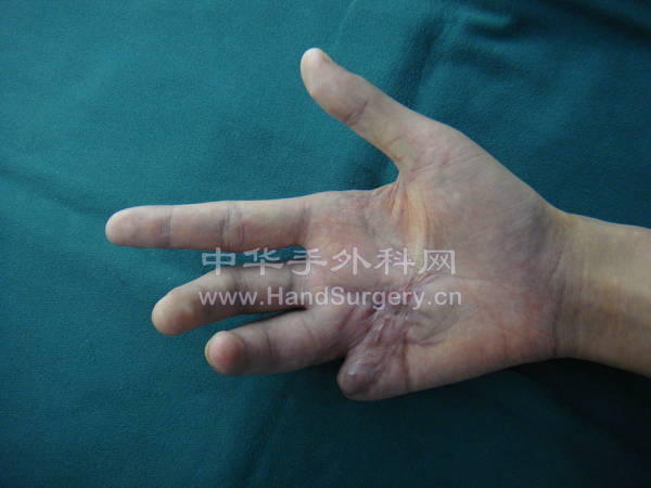 今日环指肌腱再断