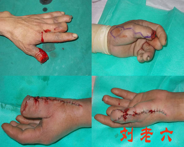 拇指桡背侧动脉皮瓣2.jpg