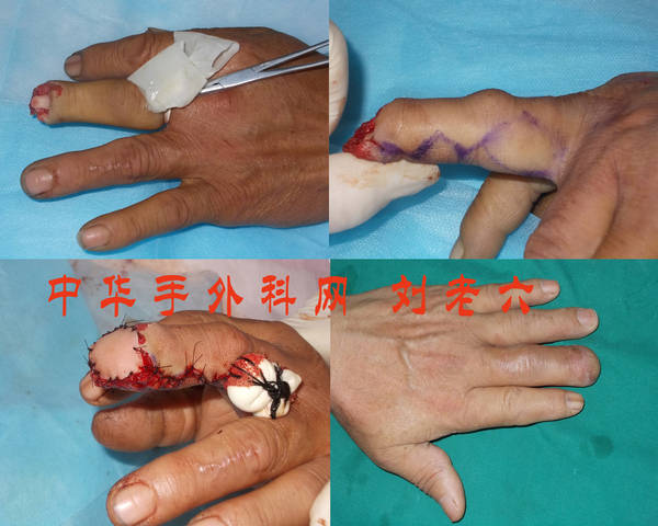 指动脉皮瓣3.jpg