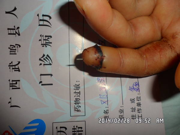 术后2周