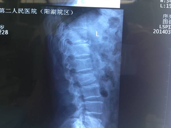L2椎体骨折情况