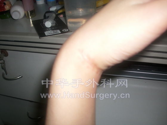 手腕1.JPG