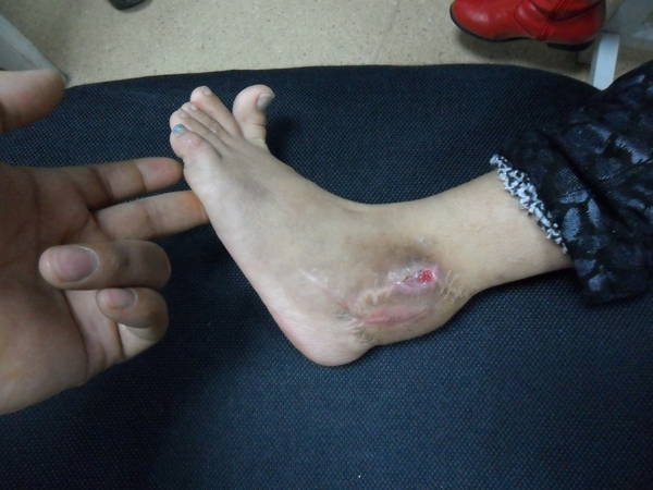 检查跟腱抗阻力