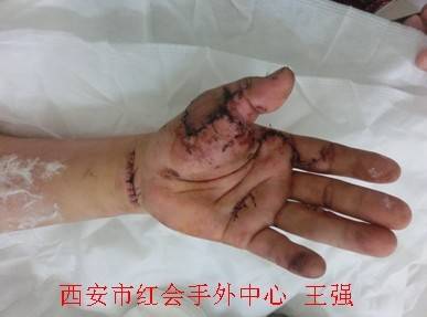 术后1周